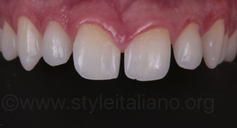 Diastema Closure