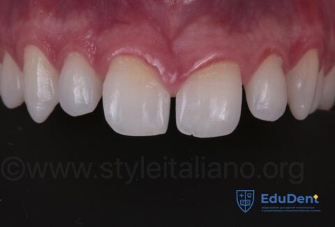 Diastema Closure