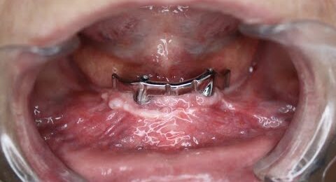 All-on-2-IMPLA-Severe-Mandibular-Atrophy-Management-1