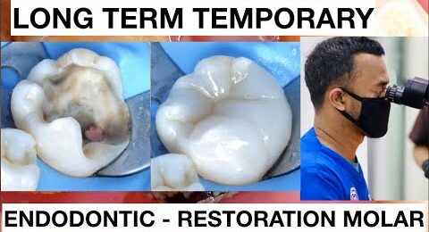 Dental-Endodontic-Direct-Restoration-Long-Term-Temporary-Composite-1