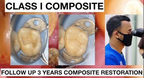 Dental-Filling-Composite-Restoration-After-3-Years-1