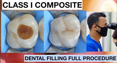 Dental-Filling-Full-Procedure-Class-1