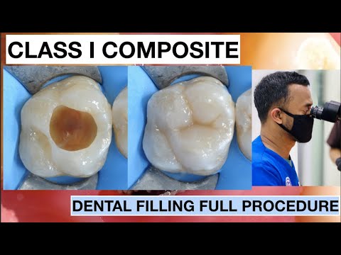 Dental-Filling-Full-Procedure-Class-1