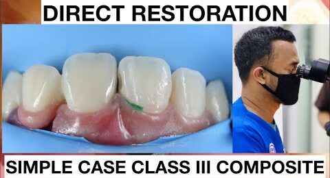 Dental-Filling-Procedure-Class-III-Composite-2