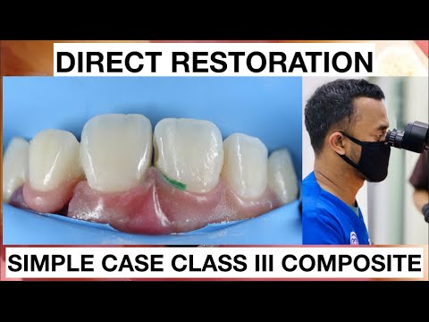 Dental-Filling-Procedure-Class-III-Composite-2