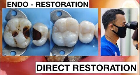 Dental-Filling-Procedure-from-Endodontic-to-Restoration-Composite-1