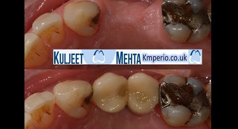 Dental-Implants-Screw-Retained-Crowns-.-1