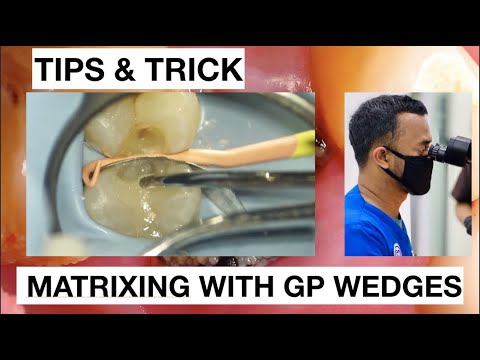 Dental-Tips-and-Tricks-Class-II-Matrixing-With-GP-Wedges-1