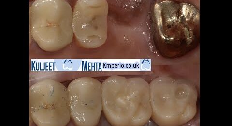 Extraction-Implant-Placement-with-Internal-Sinus-Lift-1