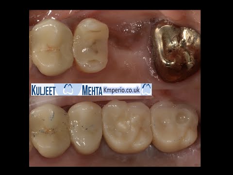 Extraction-Implant-Placement-with-Internal-Sinus-Lift-1