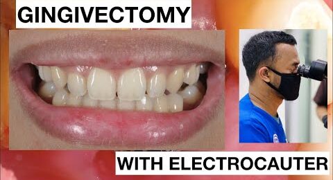 Gingivectomy-in-simple-case-Lateral-with-ElectroCautery-1