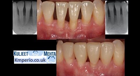 Gum-Recession-Treatment-New-Approach-1