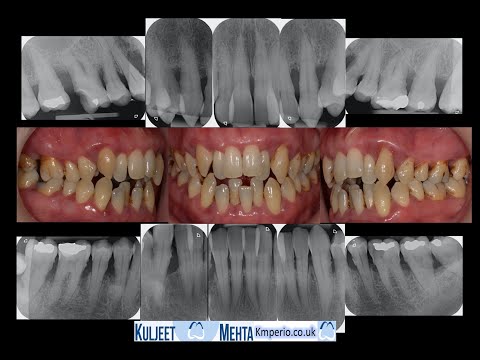 Gum-disease-treatment-1