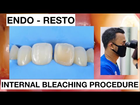 Internal-Bleaching-Teeth-Discoloration-1