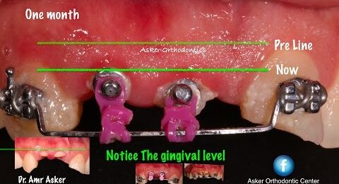 Orthodontic-extrusion-for-remaining-roots-to-get-ferrule-effect-for-bridge-ortho-course-1