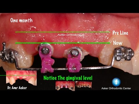 Orthodontic-extrusion-for-remaining-roots-to-get-ferrule-effect-for-bridge-ortho-course-1