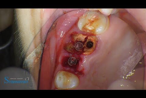 Peri-implant-tissue-management-IMPLA-Cylindrical-1