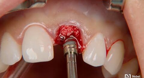 Restoration-of-a-central-incisor-1