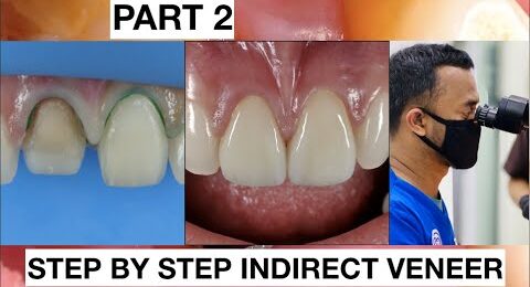 Step-by-Step-2-Indirect-Veneer-with-Discoloration-2