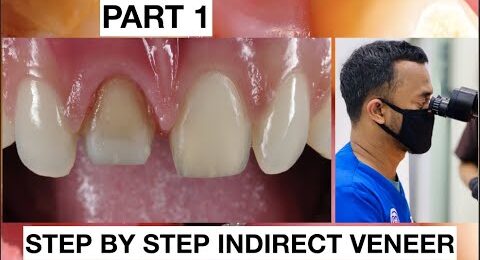 Step-by-Step-2-Indirect-Veneer-with-Discoloration2-2