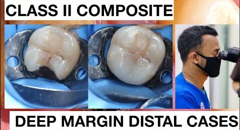 Step-by-Step-Class-II-Composite-with-Deep-Margin-Distal-1