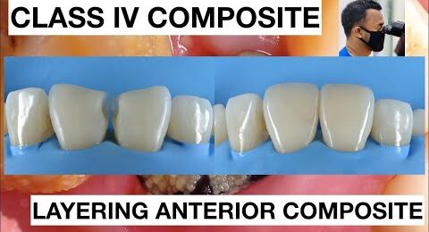 Step-by-Step-Class-IV-Composite-Restoration-Free-Hand-Technique-1