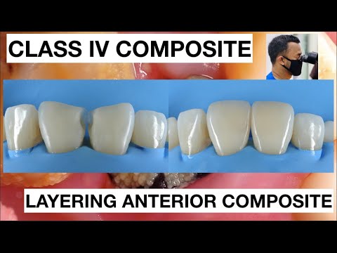 Step-by-Step-Class-IV-Composite-Restoration-Free-Hand-Technique-1