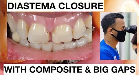 Step-by-Step-Diastema-Closure-Composite-with-Big-Gaps-1