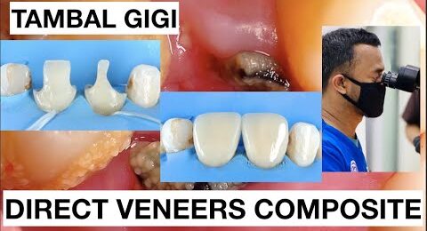 Step-by-Step-Direct-Veneer-Composite-Restoration-1