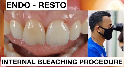 Step-by-Step-Internal-Bleaching-Teeth-Discoloration-1