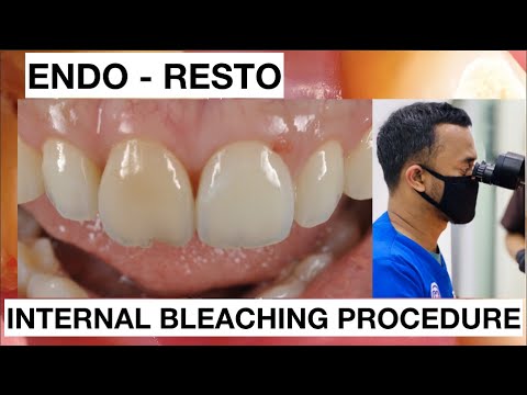 Step-by-Step-Internal-Bleaching-Teeth-Discoloration-1