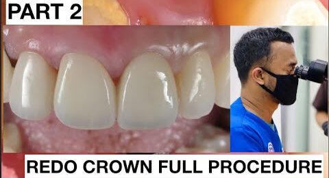 Step-by-Step-Redo-Dental-Crown-Part-2-1