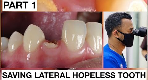 Step-by-Step-Saving-Lateral-Hopeless-Tooth-Part-1-1