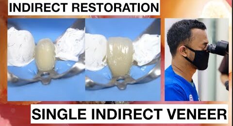 Step-by-Step-Single-Indirect-Veneer-Restoration-1