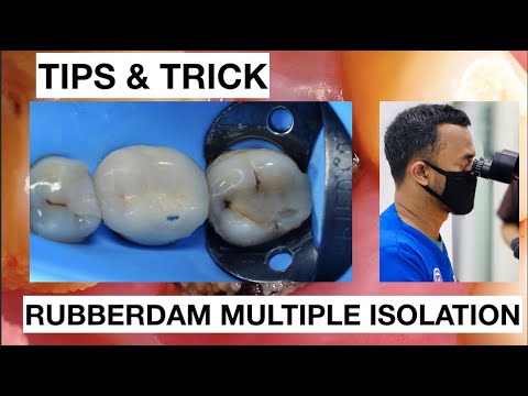 Tips-and-trick-How-To-Place-Rubberdam-On-Posterior-Lower-1